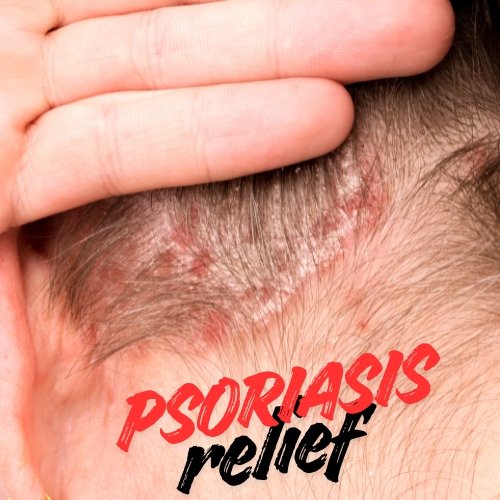 Psoriasis